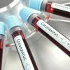 Росія визнала два перші летальні випадки від коронавірусу