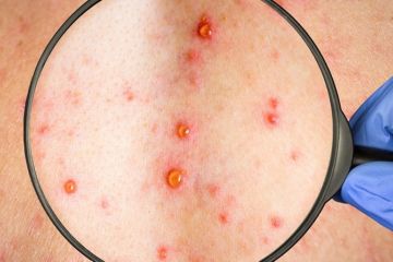 У Європі зафіксовано новий випадок смерті від мавпячої віспи  У Європі зафіксовано новий випадок смерті від мавпячої віспи