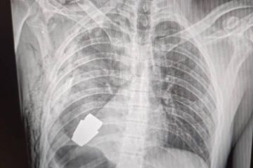 Операція під наглядом саперів: з тіла бійця ЗСУ дістали гранату ВОГ, що не розірвалася Операція під наглядом саперів: з тіла бійця ЗСУ дістали гранату ВОГ, що не розірвалася