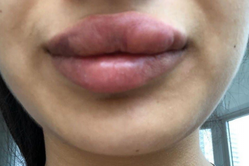 Губы лопнули, гель потек: поход к косметологу превратил жизнь в кошмар Губы лопнули, гель потек: поход к косметологу превратил жизнь в кошмар