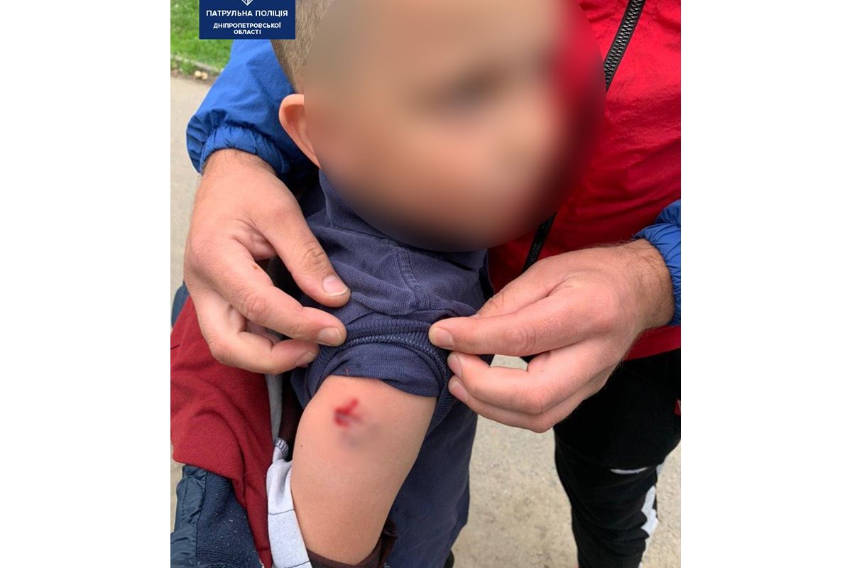 У Дніпрі пес накинувся на 7-річну дитину У Дніпрі пес накинувся на 7-річну дитину