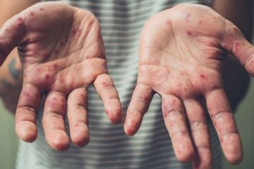 Ув’язненим Дніпровського СІЗО потрібні вакцини від кору Ув’язненим Дніпровського СІЗО потрібні вакцини від кору